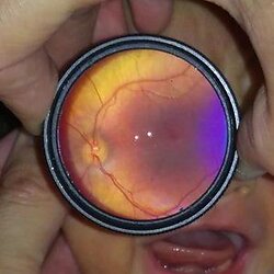 MIO Monocular Indirect Ophthalmoscope